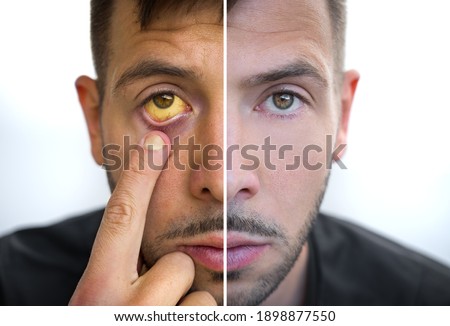Man face divided into two parts one healthy and one unhealthy. Yellowish eyes and skin. Bad habits vs good habits. Jaundice, hepatitis, cirrhosis, liver failure. Risk factors of alcohol drinking