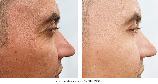 Man Face Wrinkles   After Treatments