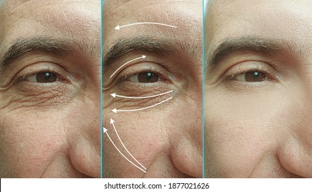 Man Face Wrinkles Before And After Treatment