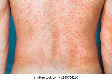 A Man Gets Ill  Urticaria