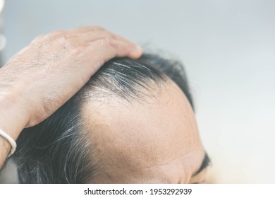 A Man With Hair Loss Problems. Care Concept. Transplantation Hair. Bald Head. Baldness Treatment. Medicine. Thick Healthy Hair. Head.