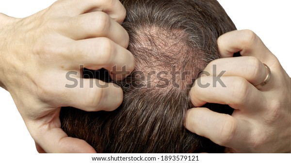 Man with hair loss problems closeup, isolated.\
Alopecia balding hairs on man scalp. Human alopecia or hair loss -\
person hand pointing his bald head. Scratching his head. Baldness.\
Depression, stress