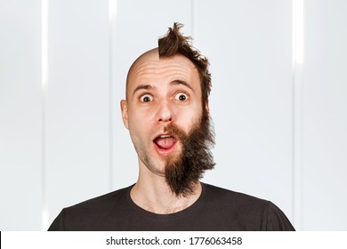 Man With Half Shaved Hair Head. Guy Before And After Transplant And Alopecia