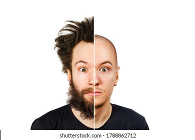 Man With Half Shaved Hair Head. Guy Before And After Transplant And Alopecia. Isolated On White