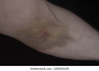 11,686 Bruise Blood Images, Stock Photos & Vectors | Shutterstock