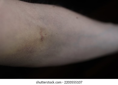 Man Hand Big Bruise After Blood Stock Photo 2203555107 | Shutterstock