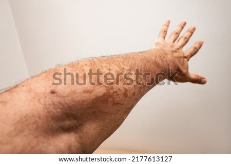 A man hand with a fungal dermatological skin disease. Symptoms of severe scratching and exfoliation of the epidermis