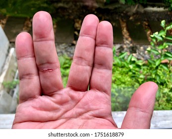 A Man Hand Got Scratch Mark By The Cat On Ring Finger