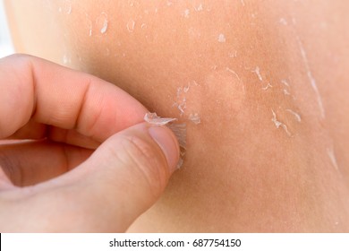 Man hand removes flaky skin from the female back - Shutterstock ID 687754150
