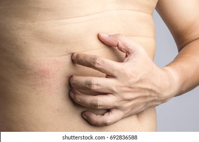 Man Hand Scratching An Itch On Red Mark Sensitive Skin As Food Or Pest Allergy Symptoms On White Background