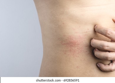 Man Hand Scratching An Itch On Red Mark Sensitive Skin As Food Or Pest Allergy Symptoms On White Background