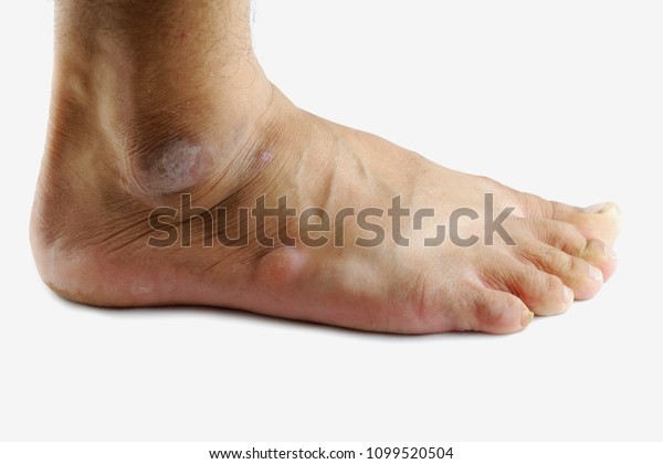 dead skin around ankles