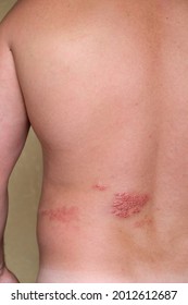 A man has herpes zoster. Red papules with fluid on the skin.The irritated skin on the man's back itches and burns.A viral disease associated with skin lesions with vesicles, skin inflammation.