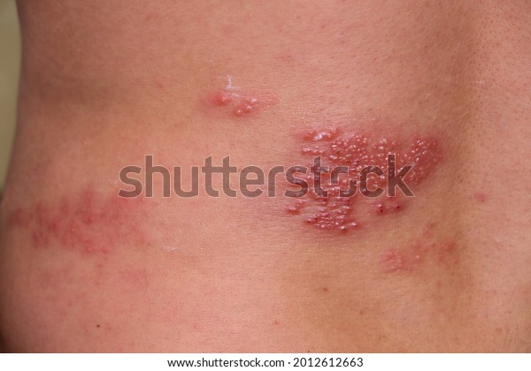 A man has herpes zoster. Red papules with
fluid on the skin.The irritated skin on the man's back itches and
burns.A viral disease associated with skin lesions with vesicles,
skin inflammation.