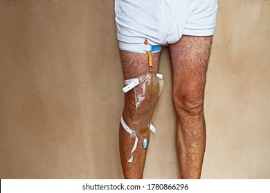 A man has a urinary catheter strapped to his leg.