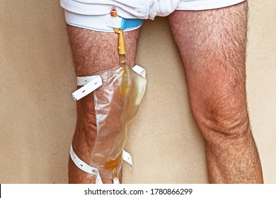 A man has a urinary catheter strapped to his leg.