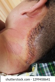 A Man Have Traumatic Brain Tumor Surgery On His Head Minimally Invasive