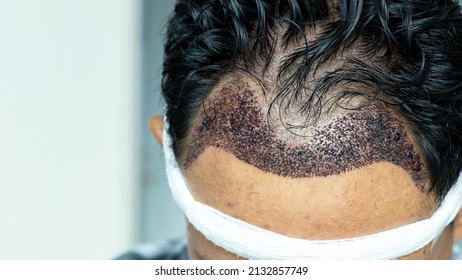14 Hair Transplant Stages Stock Photos, Images & Photography | Shutterstock