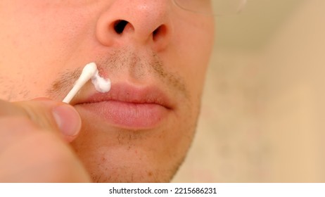 Man With Herpes On Lips Against Light Grey Background. Cold Sore On A Man Lips. Sore Virus Concept. Man Touch Sore By Cotton Swab And Use Cream For Treatment And Therapy Sore. Man Spread White Cream