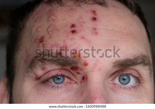 Man with\
Herpes Zoster (shingles) on the face, close up. Inflamed eyelid and\
red eye of a man suffering from herpes on the face. Purulent\
blisters on the face during\
Shingles
