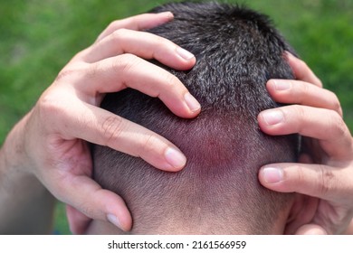 Man Holding His Head With Both Hands Because Of The Pain Caused By A Hornet Or Bee Sting