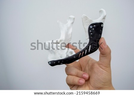 Man holding implantation of endoprosthesis of lower jaw. Model of lower jaw printed on 3D printer white plastic. Endoprosthesis printed on 3D printer for metal biocompatible titanium alloy black color