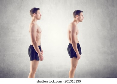 Man with impaired posture position defect scoliosis and ideal bearing