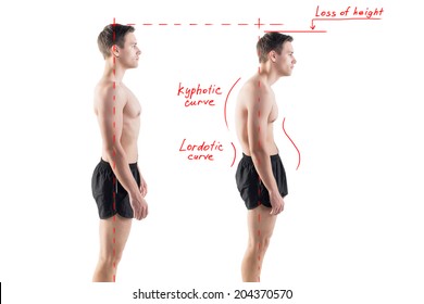 Man With Impaired Posture Position Defect Scoliosis And Ideal Bearing