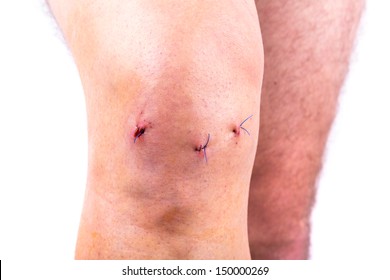 Man Knee After Arthroscopic Surgery With Stitches