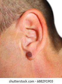 A Man With A Large Mole On His Ear. For Medicine, The Image Of The Nevus On The Human Ear, Close-up. Skin Of Melanoma
