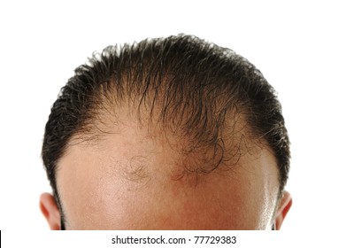 1000 Male Pattern Baldness Stock Images Photos Vectors