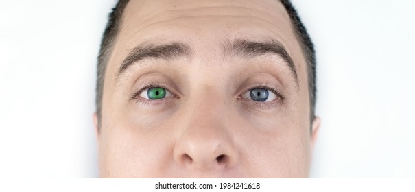 A Man With Multi Colored Eyes. The Left One Is Green And The Right One Is Blue. Gene Mutation Concept. Heterochromia.