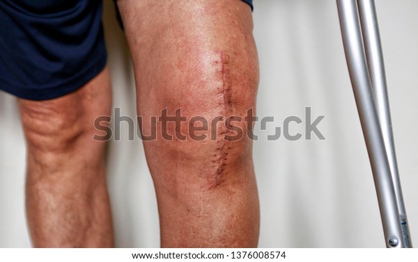Man on crutches after\
knee replacement surgery, stitches close up. Painful scar after\
knee surgery