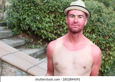 Man With Pale Complexion Getting Sunburnt 