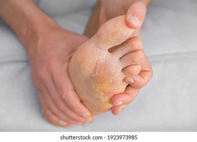 Man with peeling and cracked feet. Fungal infection or athlete's foot, dry skin, dermatitis, eczema, psoriasis, sweaty feet or dehydration. Health care concept