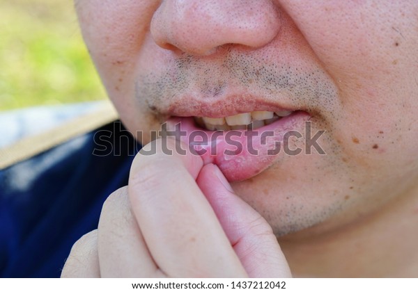 Tongue skin peeling