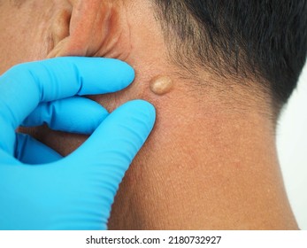 Man pointed to sebaceous cysts on his neck, formed by sebaceous glands. Oils called sebum and laser skin treatments or flea biopsies health concept. closeup photo, blurred. - Shutterstock ID 2180732927