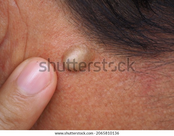 Man Pointed Sebaceous Cysts On His Stock Photo (Edit Now) 2065810136