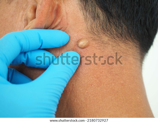 Man pointed to sebaceous\
cysts on his neck, formed by sebaceous glands. Oils called sebum\
and laser skin treatments or flea biopsies health concept. closeup\
photo, blurred.