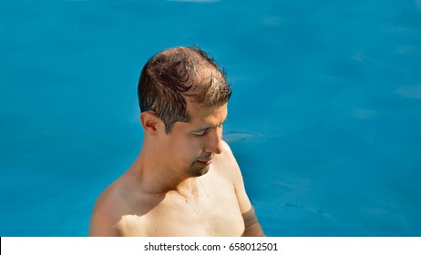 Man In A Pool And With Loss Of Hair By The Action Of Water And The Chlorine