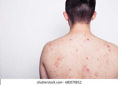 Man Posing In A Photo Studio. Thin Body That's Covered With Moles And Pimples. Troubled Skin. Skin Diseases. Dressed In Black Jeans. White Background. Back Acne