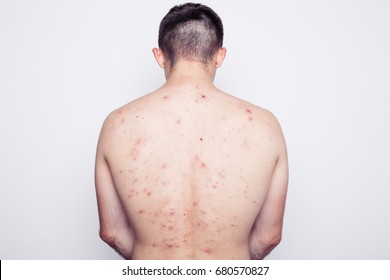 Man Posing In A Photo Studio. Thin Body That's Covered With Moles And Pimples. Troubled Skin. Skin Diseases. Dressed In Black Jeans. White Background. Back Acne