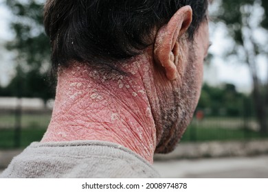 A Man With Psoriasis On His Back And Neck. Scratch With His Hand. Back, Ears With Psoriasis Skin