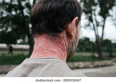 A Man With Psoriasis On His Back And Neck.