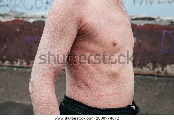 Man Psoriasis On His Back Neck Stock Photo 2008974872 Shutterstock