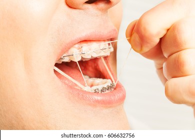 Man Put On Rubber Orthodontic Strings To Braces