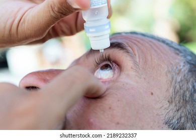 
Man Putting Eye Drops In An Irritated Eye.
Vision, Irritated Eye, Blood Vessels In The Sclera