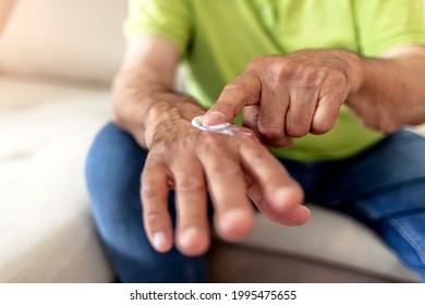 Man Putting Moisturizer Onto His Hand With Very Dry Skin And Deep Crack With Cream Due To Washing Alcohol On COVID-19 Situation. Photo Of Men Hands Using White Cream On Forefinger To Apply On Dry Skin