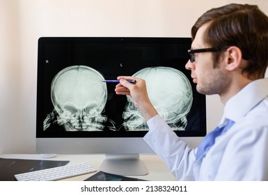 Man Radiologist Analyzing A Child Skull X Ray With Left Parietal Bone Fracture. Child Abuse 