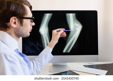 Man radiologist analyzing a patient child elbow bones x ray with a distal humerus fracture with displacement.
